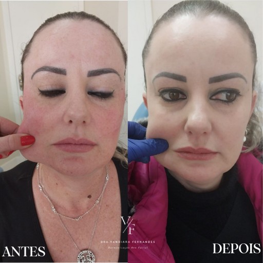 Bioestimuladores de Colágeno